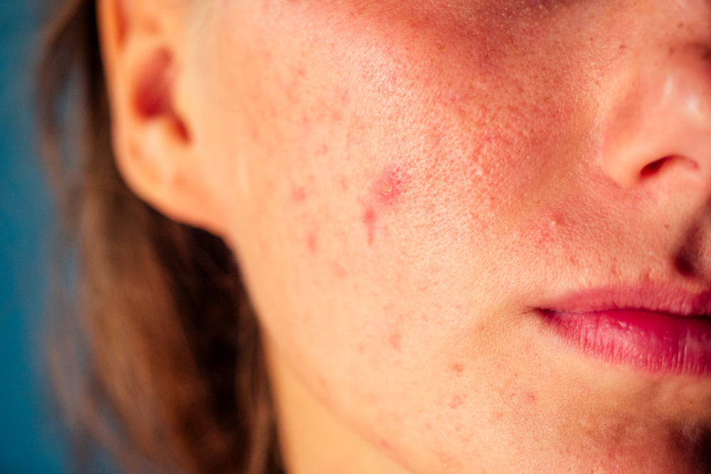 how stress affects your skin